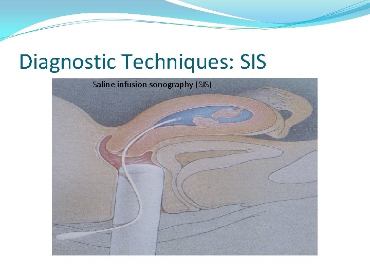 Diagnostic Techniques: SIS Saline infusion sonography (SIS) 