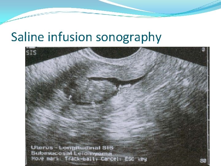 Saline infusion sonography 