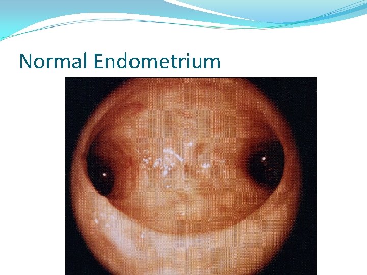 Normal Endometrium 