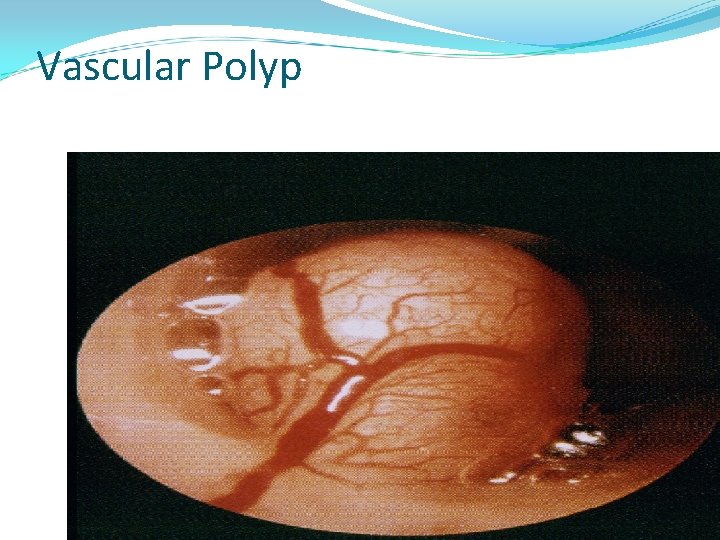 Vascular Polyp 