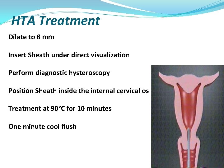 HTA Treatment Dilate to 8 mm Insert Sheath under direct visualization Perform diagnostic hysteroscopy