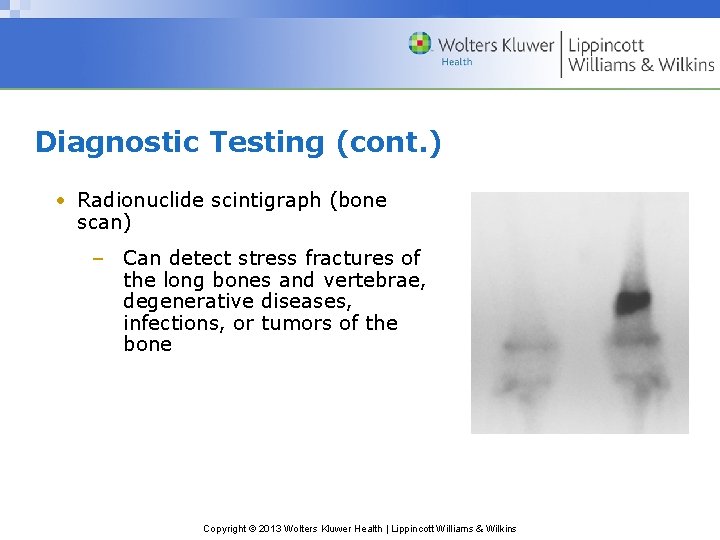 Diagnostic Testing (cont. ) • Radionuclide scintigraph (bone scan) – Can detect stress fractures