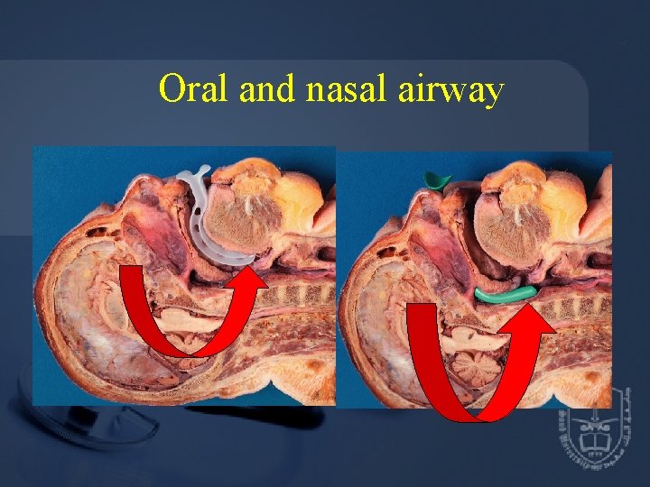 Oral and nasal airway 