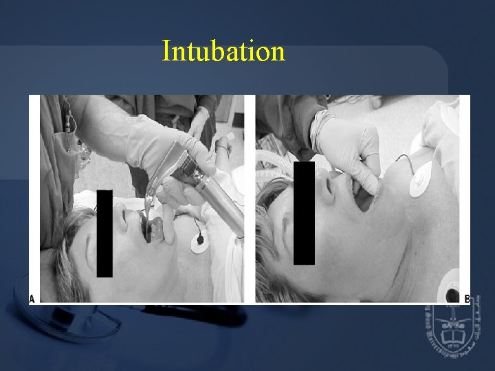 Intubation 