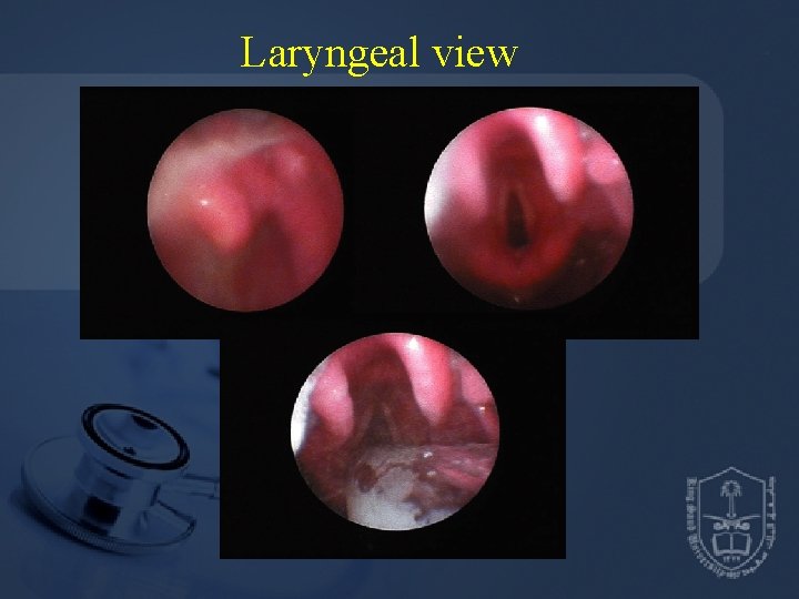 Laryngeal view 