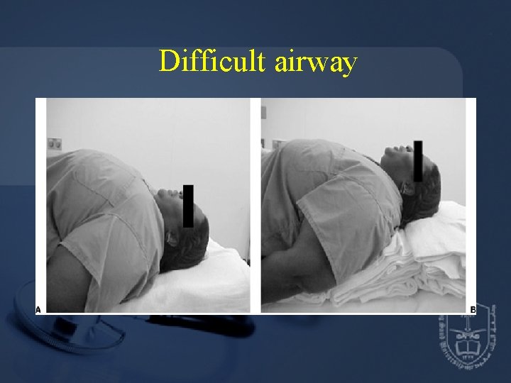 Difficult airway 