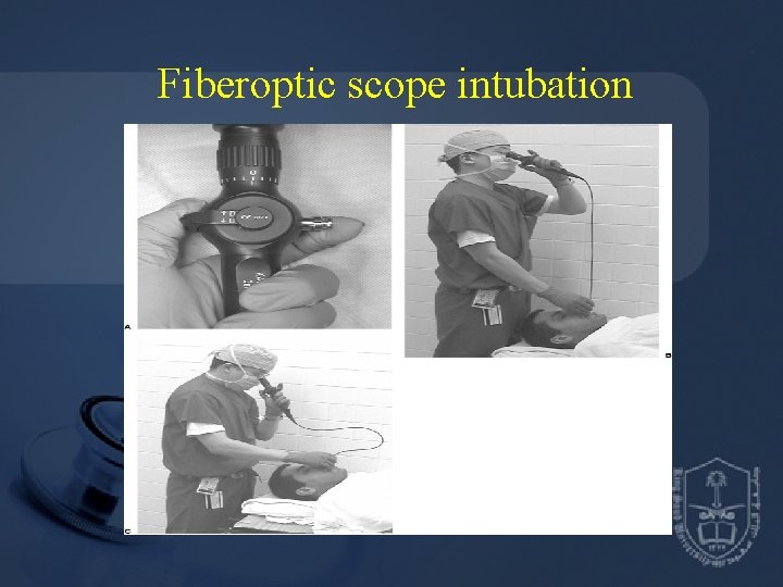 Fiberoptic scope intubation 