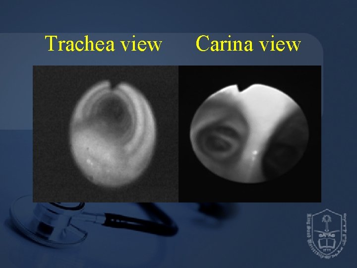Trachea view Carina view 