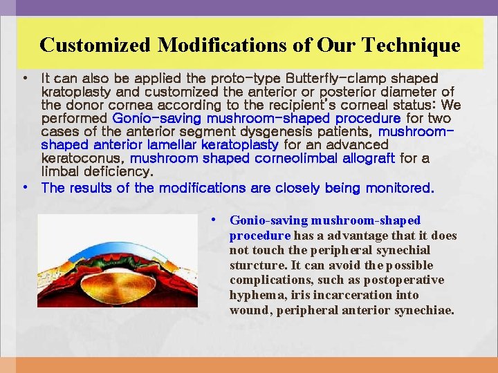 Customized Modifications of Our Technique • It can also be applied the proto-type Butterfly-clamp Customized Modifications of Our Technique • It can also be applied the proto-type Butterfly-clamp