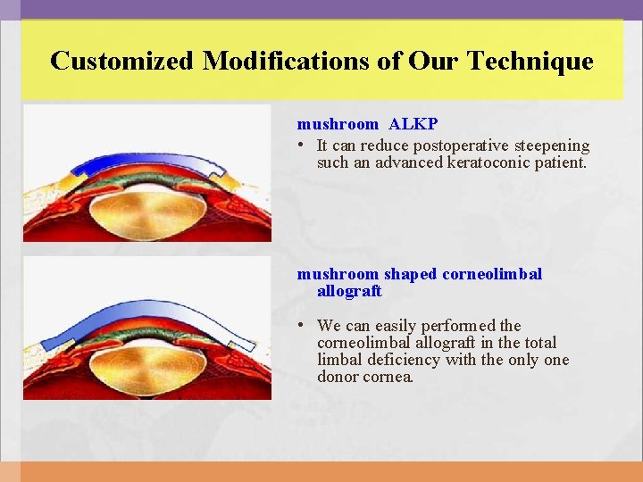 Customized Modifications of Our Technique mushroom ALKP • It can reduce postoperative steepening such Customized Modifications of Our Technique mushroom ALKP • It can reduce postoperative steepening such