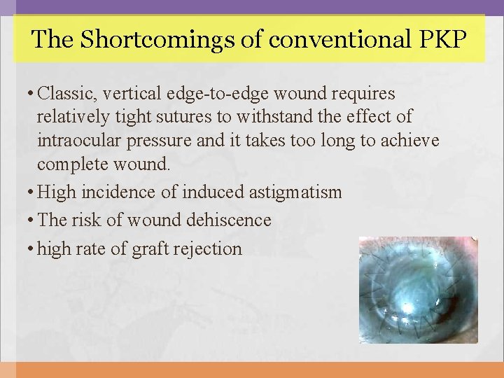 The Shortcomings of conventional PKP • Classic, vertical edge-to-edge wound requires relatively tight sutures The Shortcomings of conventional PKP • Classic, vertical edge-to-edge wound requires relatively tight sutures