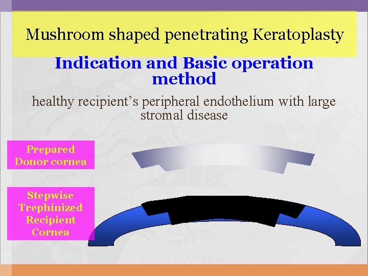 Mushroom shaped penetrating Keratoplasty Indication and Basic operation method healthy recipient’s peripheral endothelium with Mushroom shaped penetrating Keratoplasty Indication and Basic operation method healthy recipient’s peripheral endothelium with