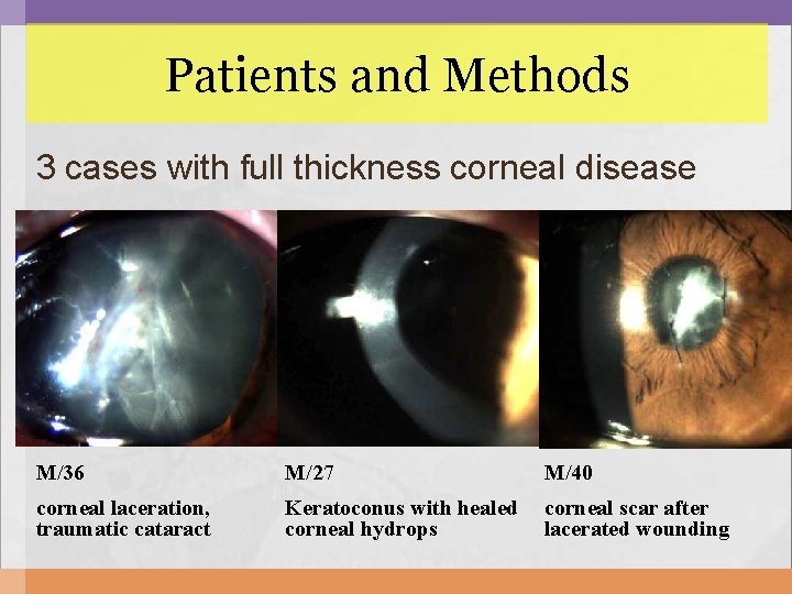 Patients and Methods 3 cases with full thickness corneal disease M/36 M/27 M/40 corneal Patients and Methods 3 cases with full thickness corneal disease M/36 M/27 M/40 corneal