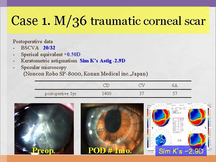 Case 1. M/36 traumatic corneal scar Postoperative data - BSCVA 20/32 - Sperical equivalent Case 1. M/36 traumatic corneal scar Postoperative data - BSCVA 20/32 - Sperical equivalent