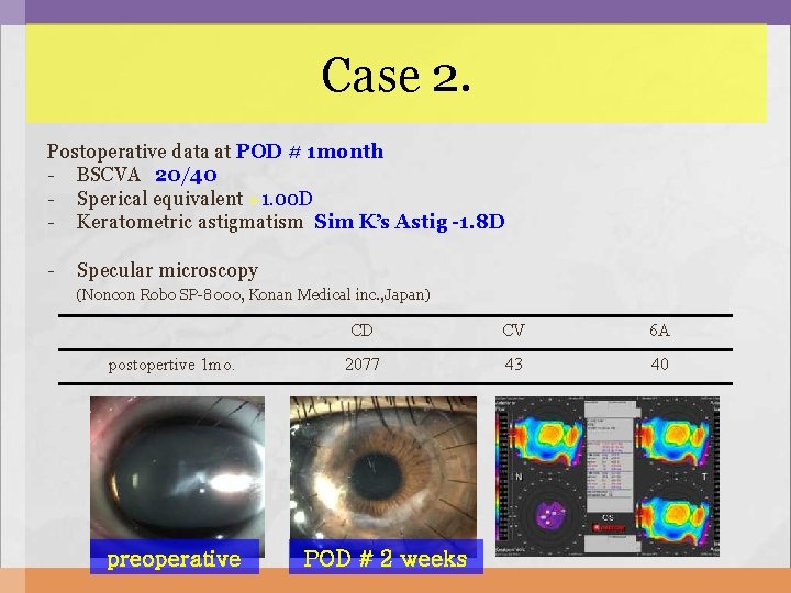 Case 2. Postoperative data at POD # 1 month - BSCVA 20/40 - Sperical Case 2. Postoperative data at POD # 1 month - BSCVA 20/40 - Sperical