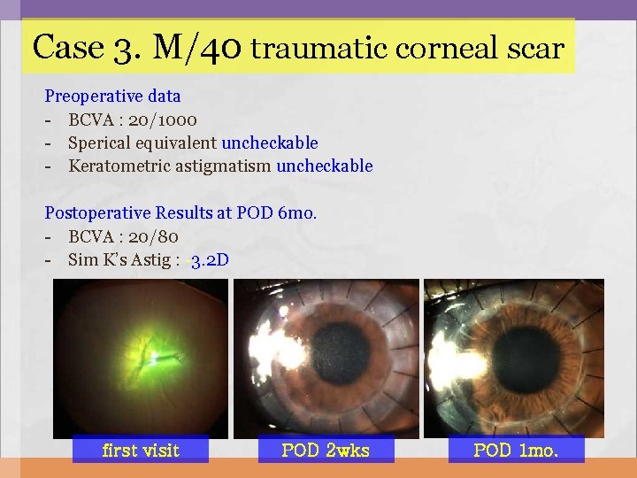 Case 3. M/40 traumatic corneal scar Preoperative data - BCVA : 20/1000 - Sperical Case 3. M/40 traumatic corneal scar Preoperative data - BCVA : 20/1000 - Sperical