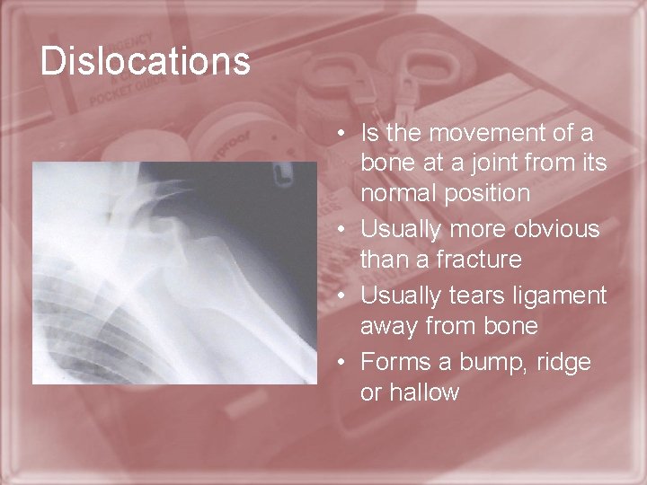 Dislocations • Is the movement of a bone at a joint from its normal