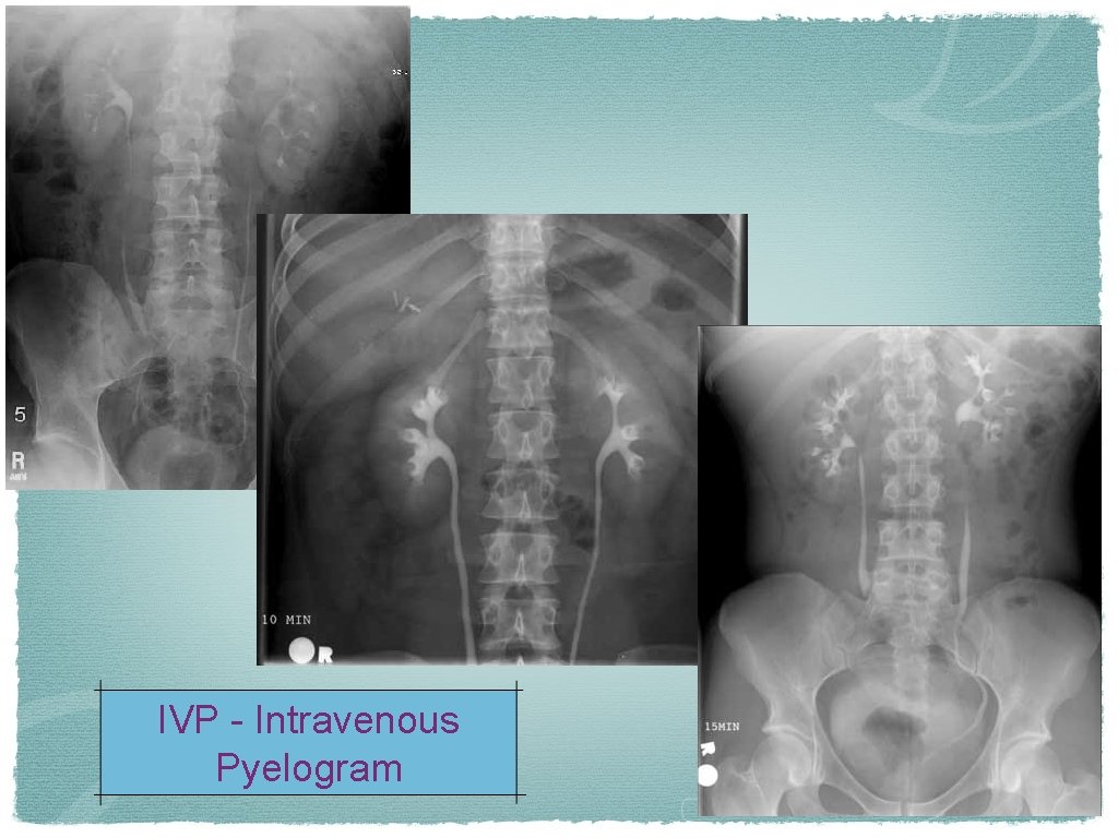 IVP - Intravenous Pyelogram 