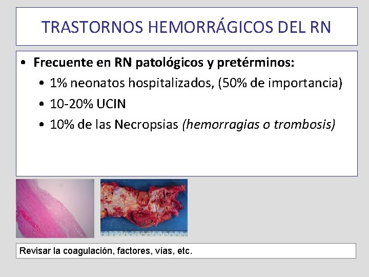 TRASTORNOS HEMORRÁGICOS DEL RN • Frecuente en RN patológicos y pretérminos: • 1% neonatos