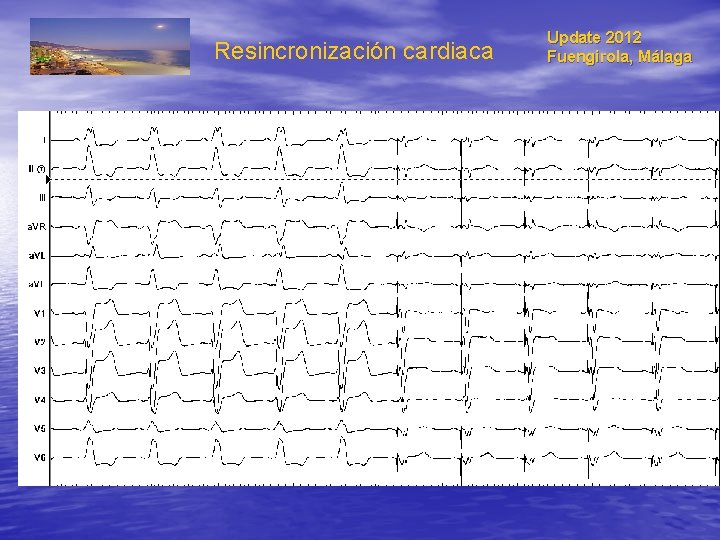 Resincronización cardiaca Update 2012 Fuengirola, Málaga 