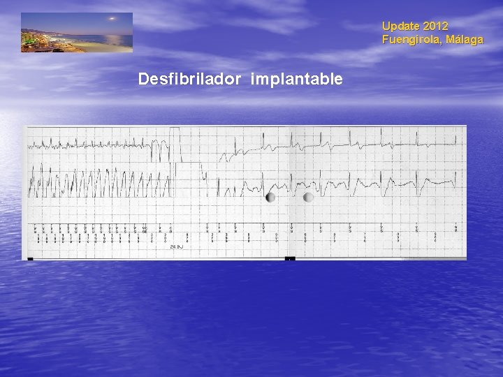 Update 2012 Fuengirola, Málaga Desfibrilador implantable 