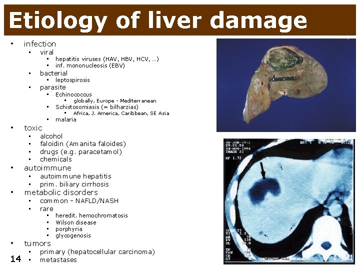Etiology of liver damage • infection • viral • bacterial • parasite • hepatitis