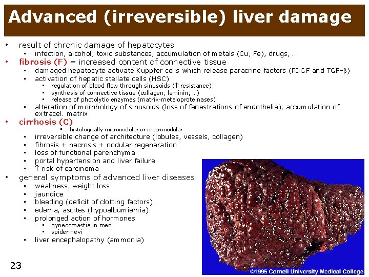 Advanced (irreversible) liver damage • result of chronic damage of hepatocytes • fibrosis (F)
