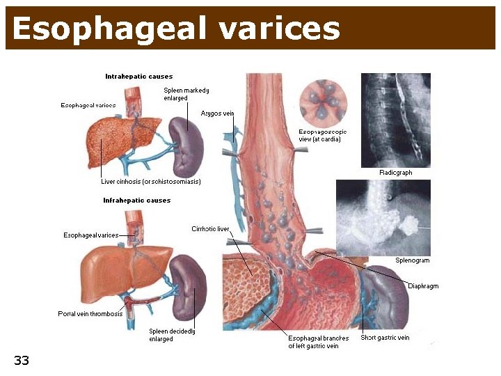 Esophageal varices 33 