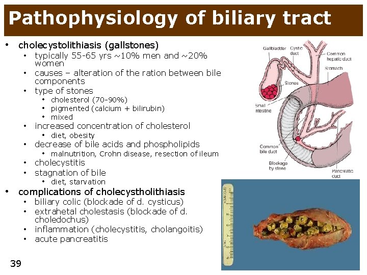 Pathophysiology of biliary tract • cholecystolithiasis (gallstones) • typically 55 -65 yrs ~10% men