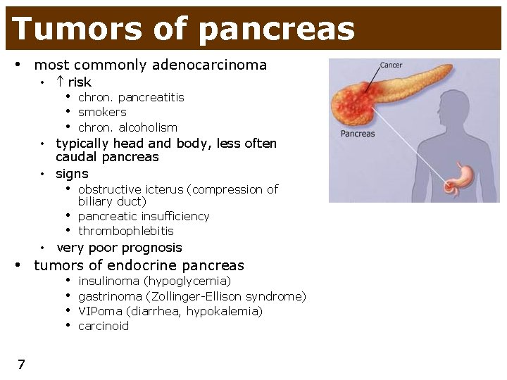 Tumors of pancreas • most commonly adenocarcinoma • risk • chron. pancreatitis • smokers