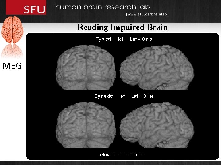 Reading Impaired Brain MEG (Herdman et al. , submitted) 