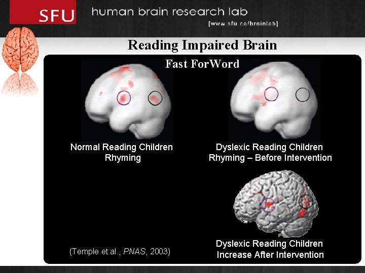 Reading Impaired Brain Fast For. Word Normal Reading Children Rhyming Dyslexic Reading Children Rhyming