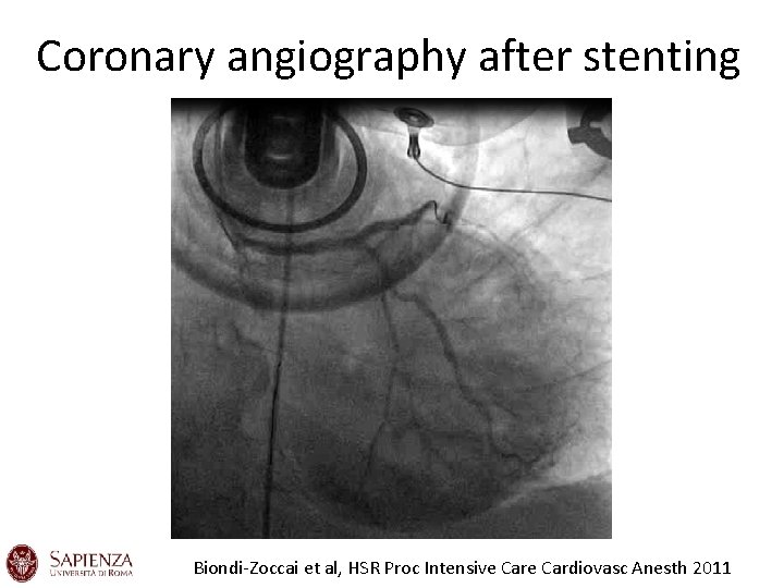 Coronary angiography after stenting Biondi-Zoccai et al, HSR Proc Intensive Cardiovasc Anesth 2011 Coronary angiography after stenting Biondi-Zoccai et al, HSR Proc Intensive Cardiovasc Anesth 2011