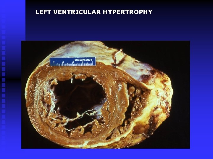 LEFT VENTRICULAR HYPERTROPHY 