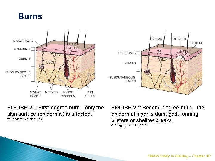 Burns FIGURE 2 -1 First-degree burn—only the skin surface (epidermis) is affected. © Cengage