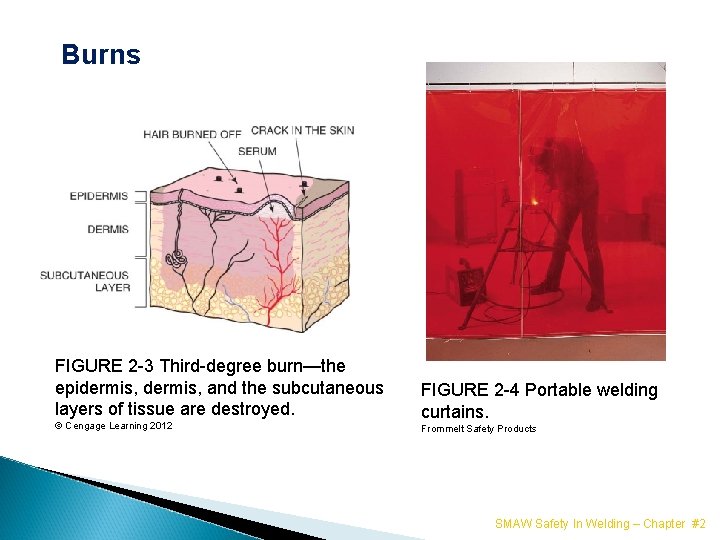Burns FIGURE 2 -3 Third-degree burn—the epidermis, and the subcutaneous layers of tissue are