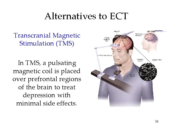 Alternatives to ECT Transcranial Magnetic Stimulation (TMS) In TMS, a pulsating magnetic coil is