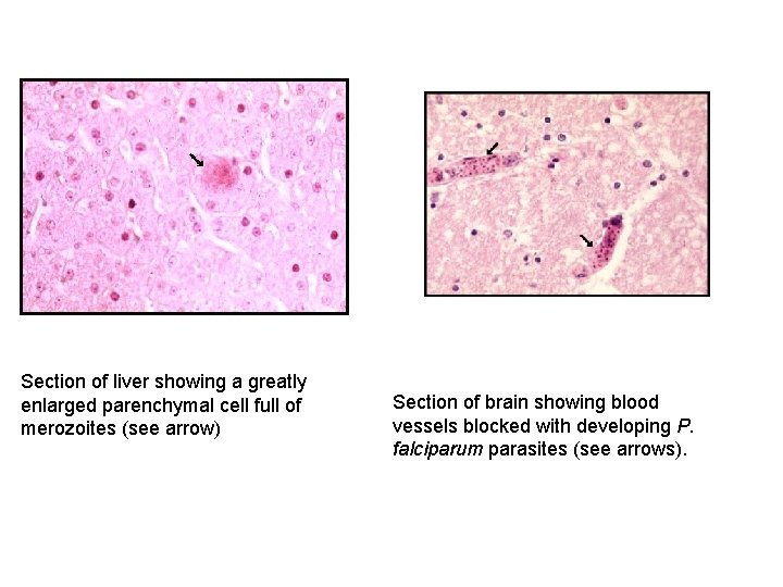 Section of liver showing a greatly enlarged parenchymal cell full of merozoites (see arrow)
