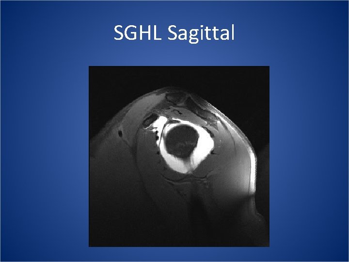 SGHL Sagittal 