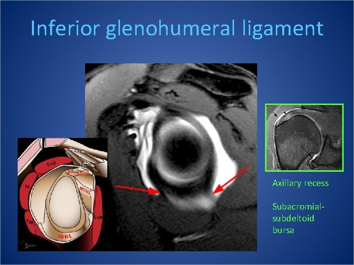 Inferior glenohumeral ligament Axillary recess Subacromialsubdeltoid bursa 