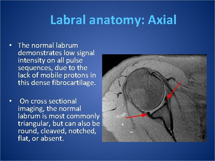 Labral anatomy: Axial • The normal labrum demonstrates low signal intensity on all pulse
