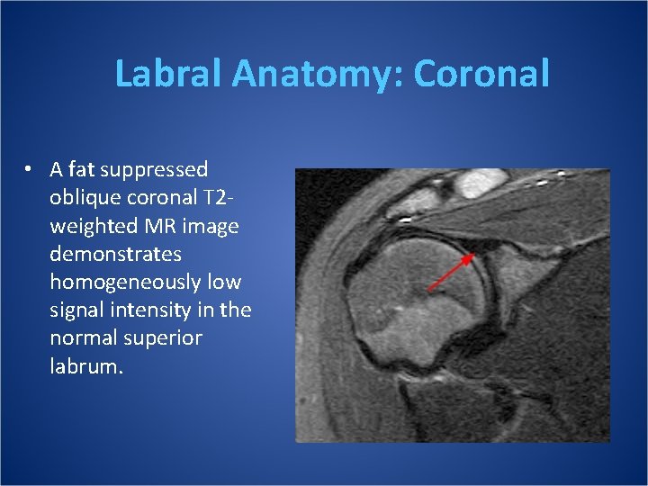 Labral Anatomy: Coronal • A fat suppressed oblique coronal T 2 weighted MR image