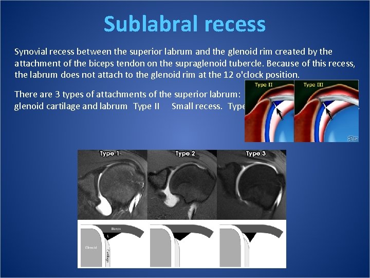 Sublabral recess Synovial recess between the superior labrum and the glenoid rim created by