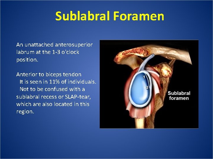 Sublabral Foramen An unattached anterosuperior labrum at the 1 -3 o'clock position. Anterior to