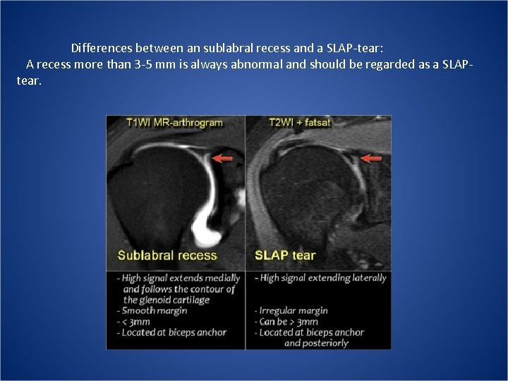 Differences between an sublabral recess and a SLAP-tear:  A recess more than 3 -5