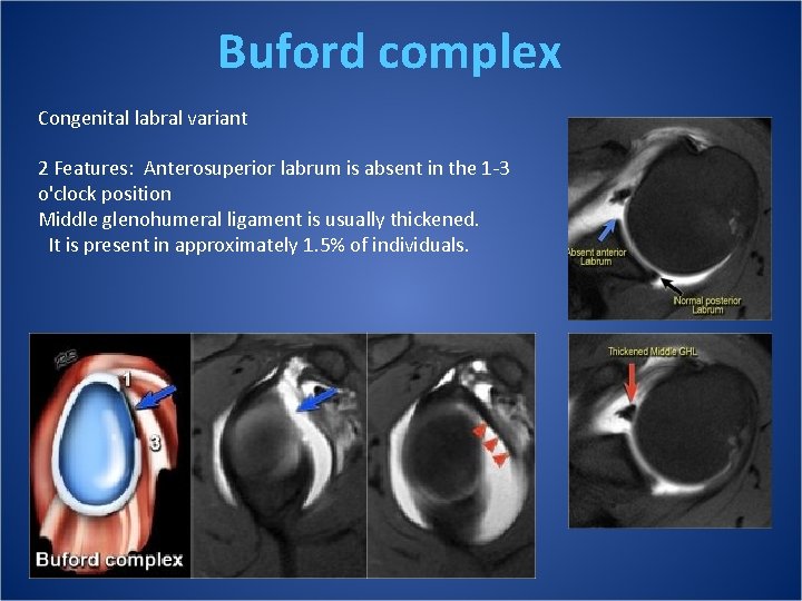 Buford complex Congenital labral variant 2 Features:  Anterosuperior labrum is absent in the 1