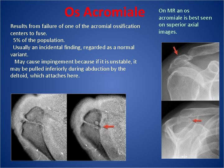 Os Acromiale Results from failure of one of the acromial ossification centers to fuse.