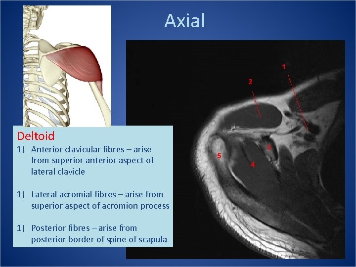 Axial Deltoid 1) Anterior clavicular fibres – arise from superior anterior aspect of lateral