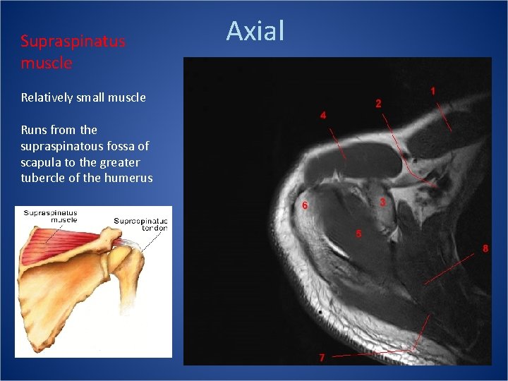 Supraspinatus muscle Relatively small muscle Runs from the supraspinatous fossa of scapula to the