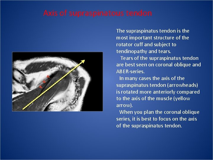 Axis of supraspinatous tendon The supraspinatus tendon is the most important structure of the